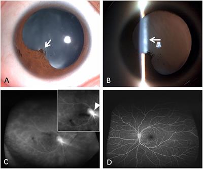 Case report: Ultrasound biomicroscopy as a guide for the selection of injection sites for dexamethasone intravitreal implant (Ozurdex) for peripheral granulomatous ocular toxocariasis in children